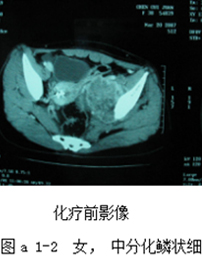 表现为下肢深静脉血栓的盆腔恶性肿瘤2例报告并