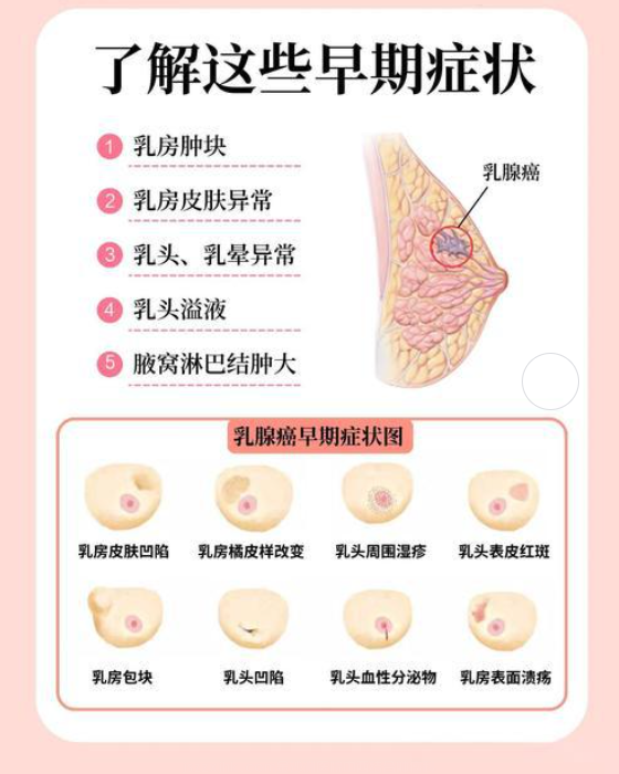 广州肿瘤医院马晓东医师医生：乳腺癌早期的蛛丝马迹，症状分析