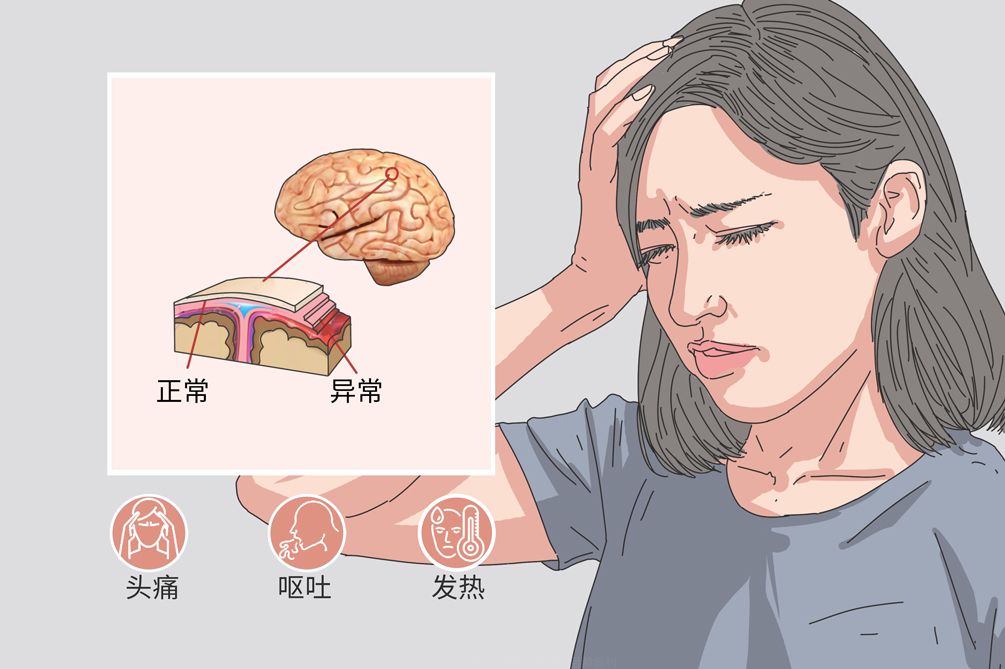广州中医药大学金沙洲肿瘤医院张涵英主任医师讲解：脑膜瘤钙化它有哪些症状！