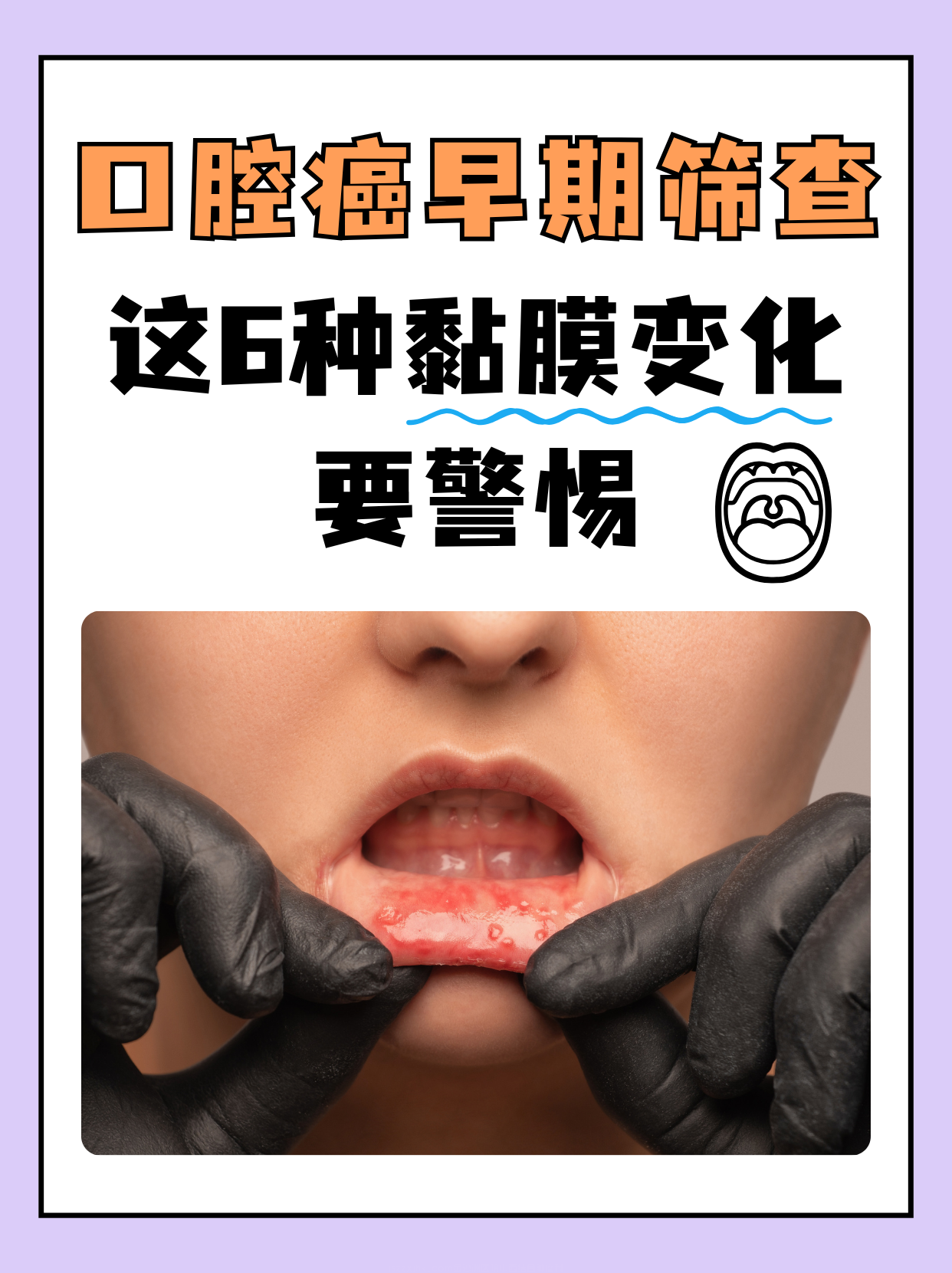 广州中医药大学金沙洲肿瘤医院徐肖峰医生提示：口腔癌筛查，为您的口腔健康筑起第一道防线！